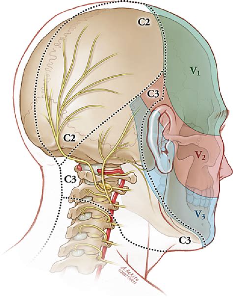 Figure 1 From Pain Relief After Cervical Ganglionectomy C2 And C3 For
