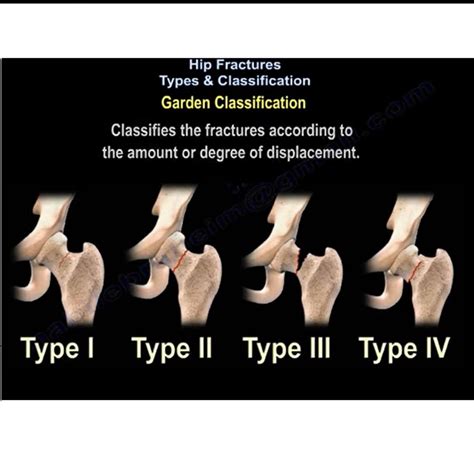 Hip Fractures Types And Classifications Orthopaedicprinciples