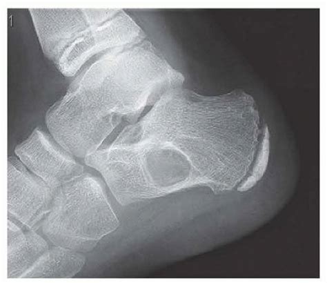 Aneurysmal Bone Cyst Foot