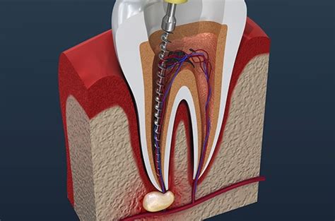 Dental crowns, dentures, and dental implants are major procedures that. Root Canal Cost and How to Reduce Them | Dentist Canberra