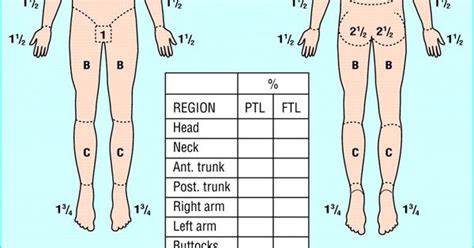 Rule Of 9s Burn Chart Physical Therapy Health And Fitness Pinterest