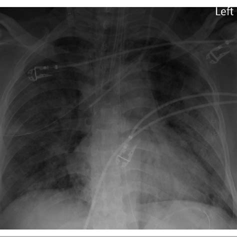 Initial Chest X Ray Cxr On Admission Showed Diffuse Bilateral