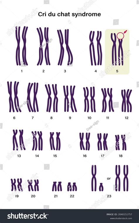 Human Karyotype Cri Du Chat Syndrome Shutterstock