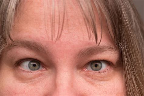 Common Causes And Misconceptions Of Lazy Eye Eye Heal