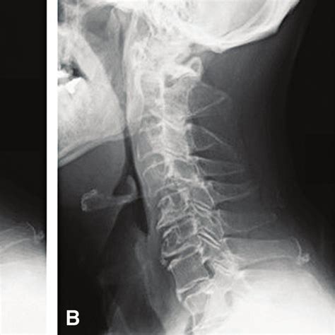 Preoperative Cervical Spinal Ct At The Level Of C1 2 A Lateral View