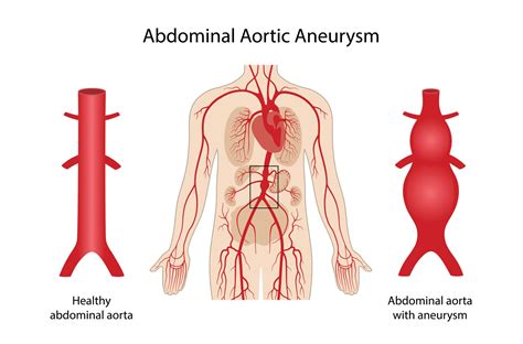 Abdominal Aortic Aneurysms — Vascular Cures