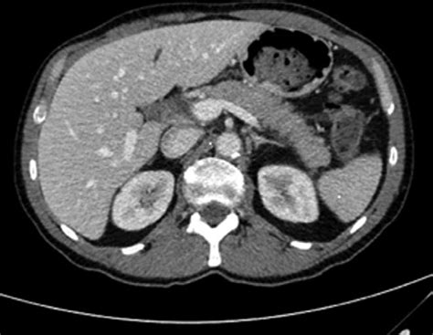 Abdominal Ct Scan Showing Swollen Pancreas Ct Computed Tomography