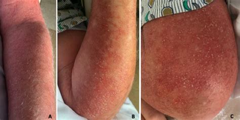 Beware Of Rashes In Covid 19 Patients Medpage Today
