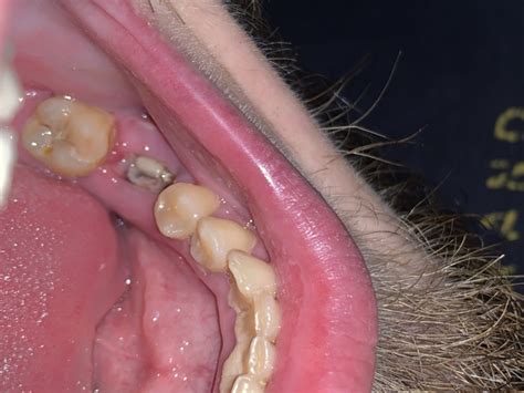 After the extraction and the anesthesia reduced to zero in the mouth, the pain may increase. Molars sacrificed for wisdom tooth