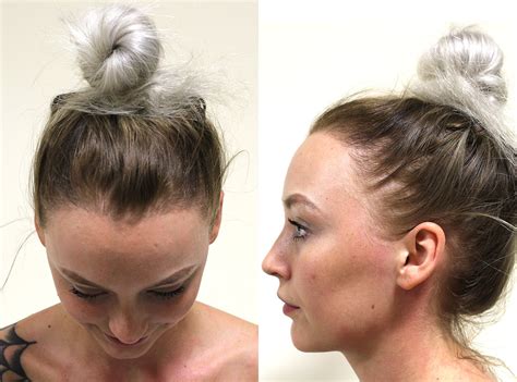 This Woman Started Balding Because Of Her Too Tight Buns SELF