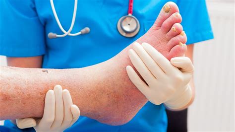 Diabetic Foot Syndrome Description And Recommendations