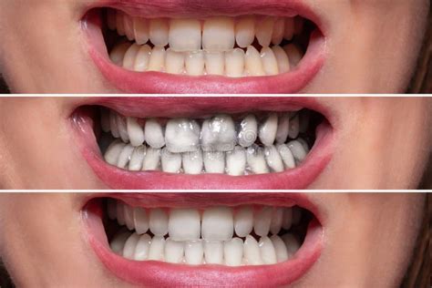Dentes Pessoais Antes E Depois Da Limpeza Imagem De Stock Imagem De