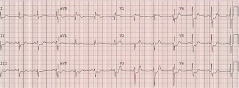 Dr Smiths Ecg Blog St Elevation In Avr With Widespread St Depression