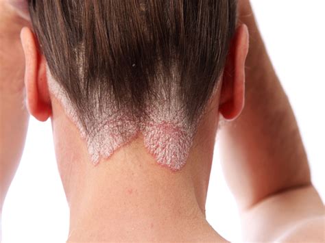 Causes And Treatment Of Seborrheic Dermatitis Hair Loss 56 Off