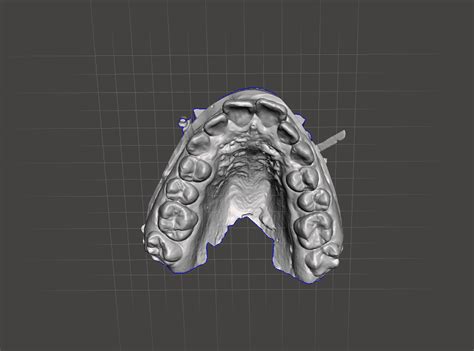 Download Stl File Orthodontics Dental Model 2 3d Print Object ・ Cults