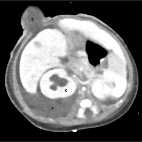 Ct Abdomen With Iv Contrast Axial View Note The Fluid Collection F