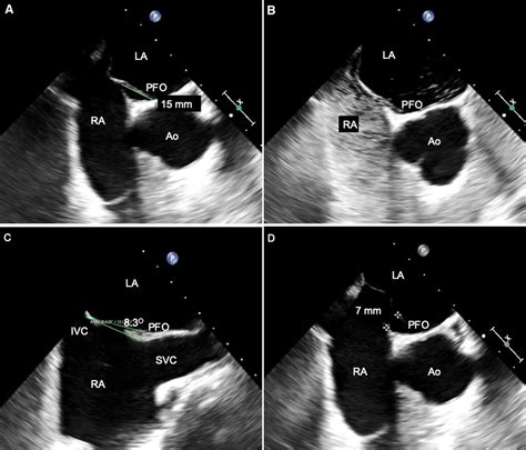 Patent Foramen Ovale Closure Circulation Cardiovascular Imaging