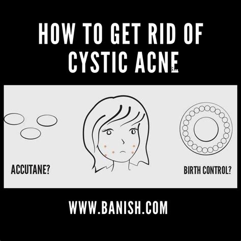 How To Treat Cystic Acne Expert Recommendations And Treatment