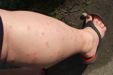 6 Mostly Natural Ways To Prevent Mosquito Bites