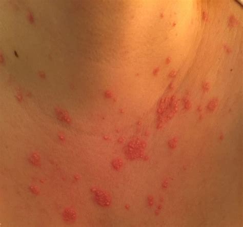 The Tender Red Maculopapular Rash In The Patients Chest During Her