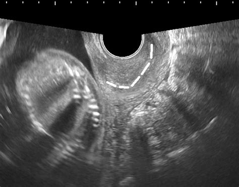 Transvaginal Ultrasonography At 20 Wk Of Gestation After Manual