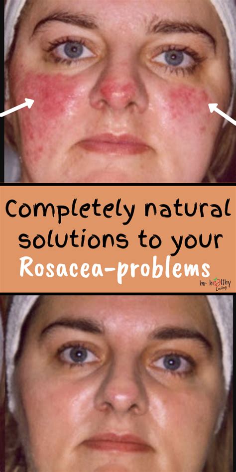 Completely Natural Solutions To Your Rosacea Problems Skincare Diy