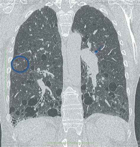Lung Complications Of Sjogren Syndrome European Respiratory Society