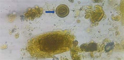 Pathology Outlines Urine Crystals Microscopy