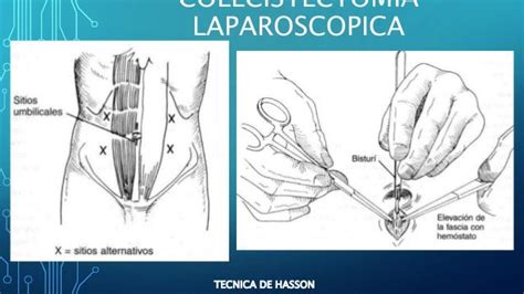 Colecistectomia Laparotomica