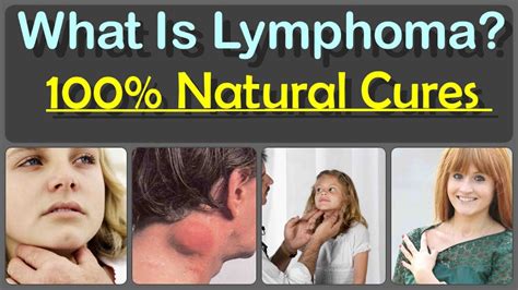 What Is Lymphoma Do You Know About Lymphoma 100 Natural Cures For