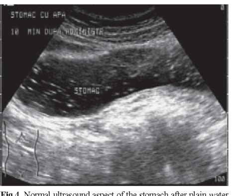 Pdf Ultrasound Examination Of The Normal Gastrointestinal Tract