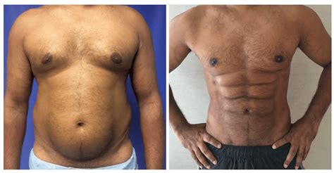 New Plastic Surgery Procedure Promises To Give You Six Pack Abs