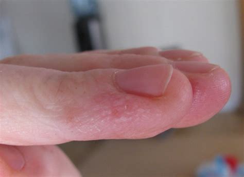 Clear Fluid Filled Bumps On Hands Pictures Photos