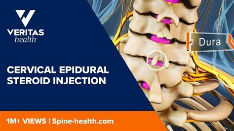 Cervical Epidural Steroid Injection Youtube