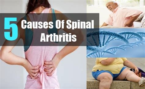Causes Of Spinal Arthritis Spinal Arthritis Arthritis Spinal