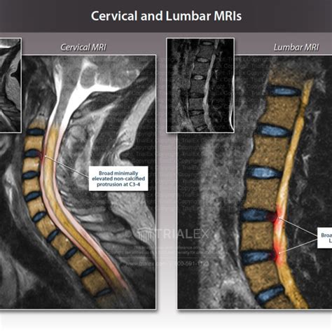 Cervical And Lumbar Mris Trialexhibits Inc