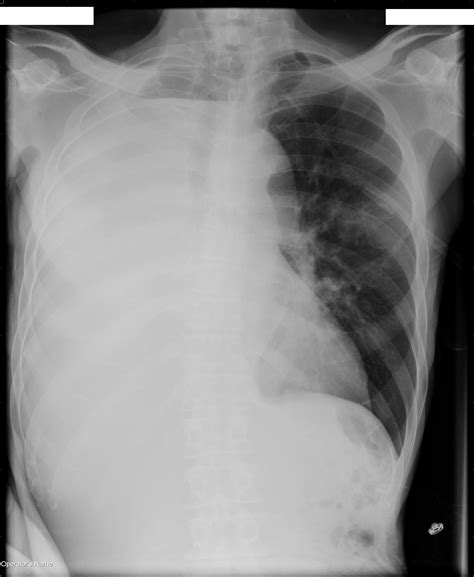 Near Complete Opacification Of The Right Hemithorax