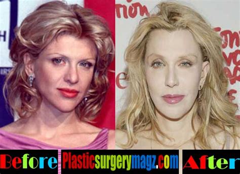 Courtney Love Plastic Surgery Before And After Plastic Surgery Magazine