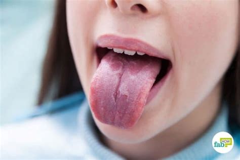 7 Home Remedies To Get Rid Of Burning Mouth Syndrome Fab How