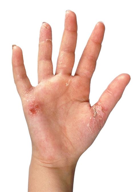 Girls Hand Affected By Contact Dermatitis Photograph By Jim Selbyscience Photo Library