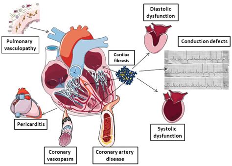 Fig 1 Schematic Overview Of The Cardiac Involvement In Patients