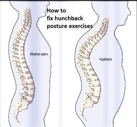 How To Fix Hunchback Posture Exercises Top 20 Remedies Home