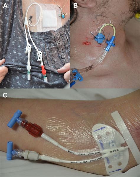 To streamline patient care, our arrow® cvcs are now available with pressure injection capabilities. Central venous catheters | The BMJ