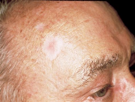 What Does Skin Cancer On Forehead Look Like