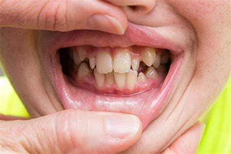 Crooked Teeth In Children Teeth And Adults Causes And Treatments