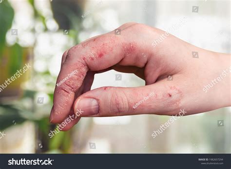 56609 Peeling Skin Hands Images Stock Photos And Vectors Shutterstock