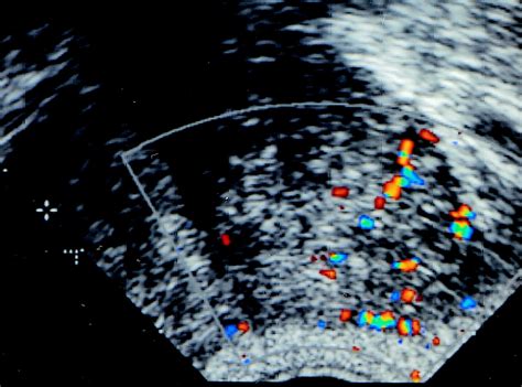 Endorectal Color Doppler Sonography And Endorectal Mr Imaging Features Of Nonpalpable Prostate