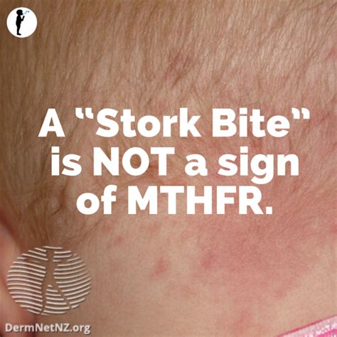 A “stork Bite” Is Not A Sign Of Mthfr Naturopathic Pediatrics