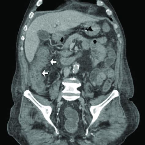 Endoscopic Appearance Of Colitis Cystic Profunda A Polypoid Lesion In