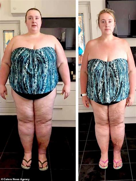 Woman Left With 15lbs Of Saggy Skin After Losing 12st Hopes To Raise £